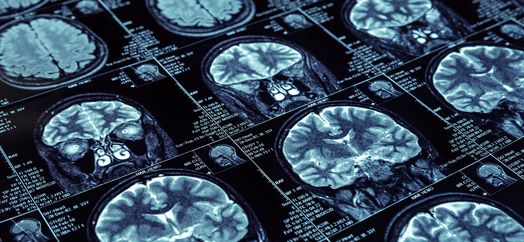 Cannabis Does Not Cause Morphological Changes in the Brain, Two Studies Find